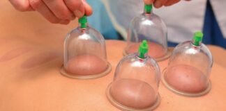 cupping therapy