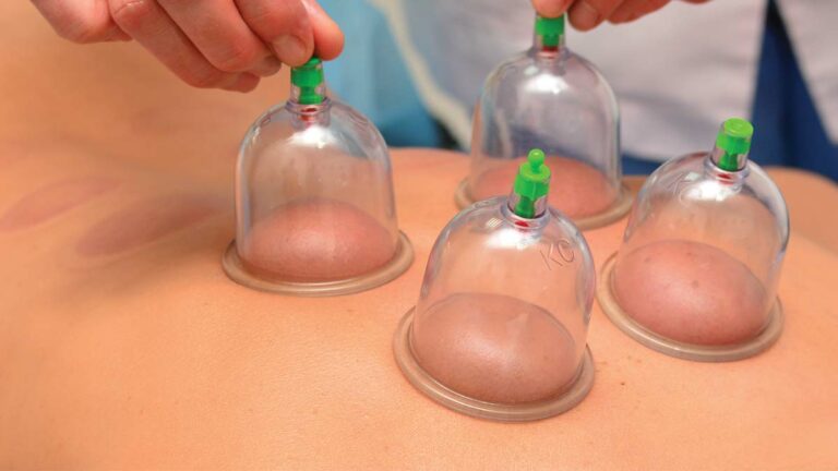 Cupping Therapy: Is it Legit?